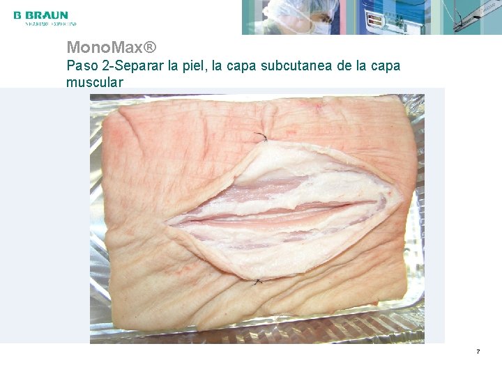 Mono. Max® Paso 2 -Separar la piel, la capa subcutanea de la capa muscular
