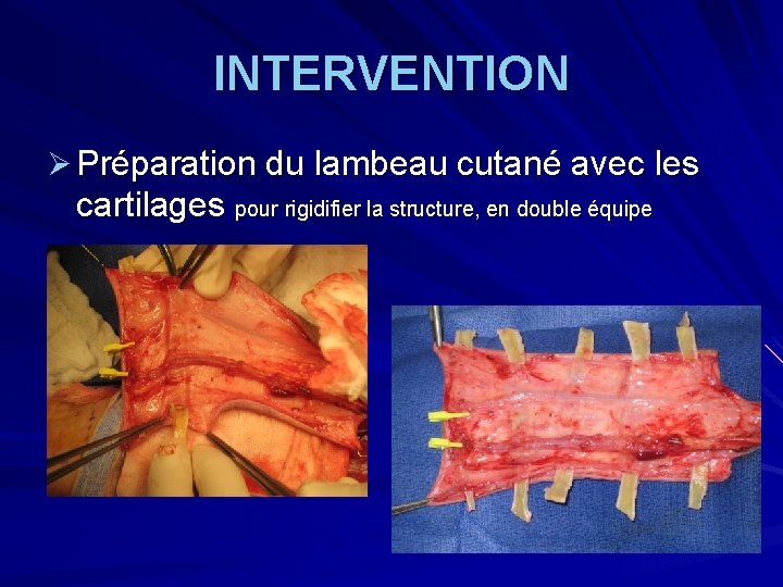 INTERVENTION Ø Préparation du lambeau cutané avec les cartilages pour rigidifier la structure, en