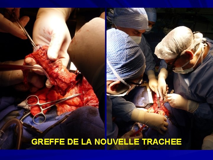 GREFFE DE LA NOUVELLE TRACHEE 