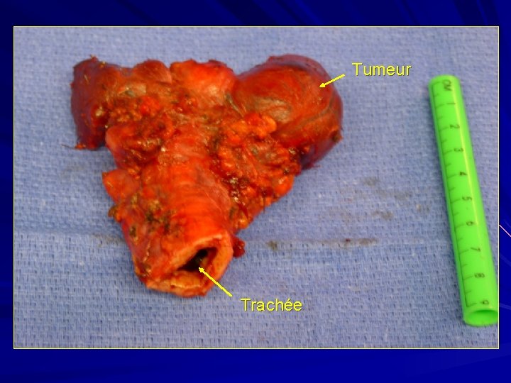 Tumeur Trachée 
