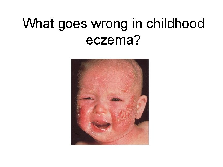 What goes wrong in childhood eczema? 