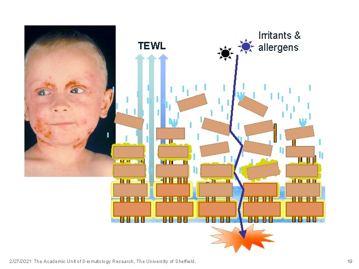 TEWL 2/27/2021 The Academic Unit of Dermatology Research, The University of Sheffield. Irritants &