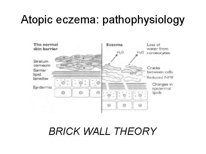 Atopic eczema: pathophysiology BRICK WALL THEORY 