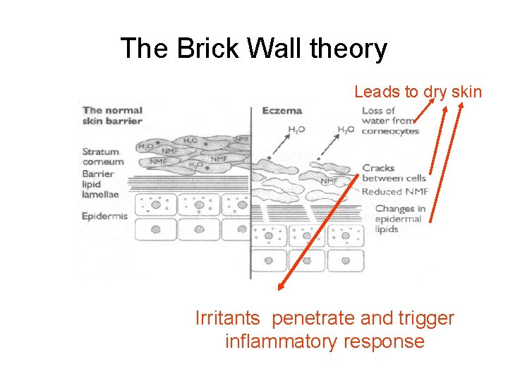 The Brick Wall theory Leads to dry skin Irritants penetrate and trigger inflammatory response