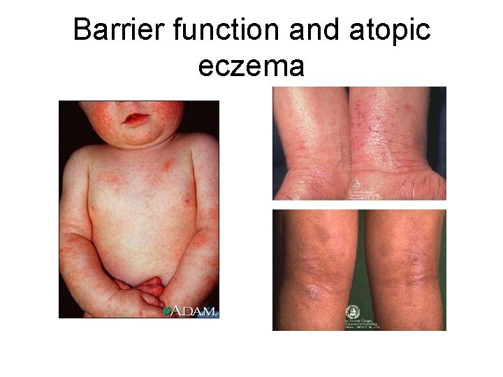 Barrier function and atopic eczema 