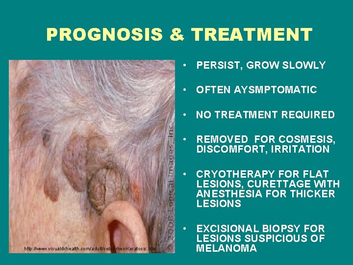 PROGNOSIS & TREATMENT • PERSIST, GROW SLOWLY • OFTEN AYSMPTOMATIC • NO TREATMENT REQUIRED