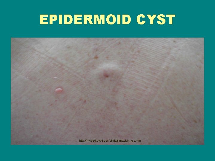 EPIDERMOID CYST http: //meded. ucsd. edu/clinicalimg/skin_eic. htm 