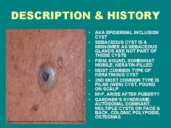 DESCRIPTION & HISTORY • • http: //www. visualdxhealth. com/adult/epidermoid. Cyst. Sebaceous. Cyst. htm AKA