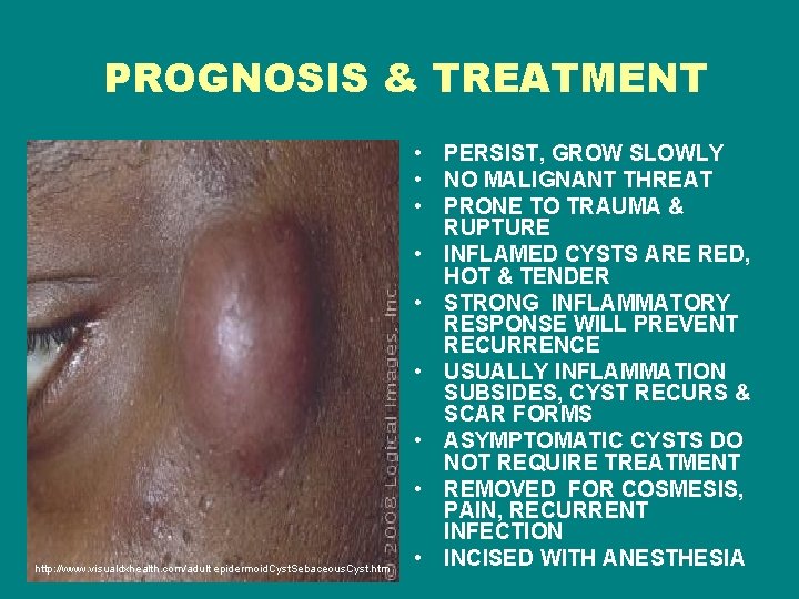 PROGNOSIS & TREATMENT http: //www. visualdxhealth. com/adult epidermoid. Cyst. Sebaceous. Cyst. htm • PERSIST,