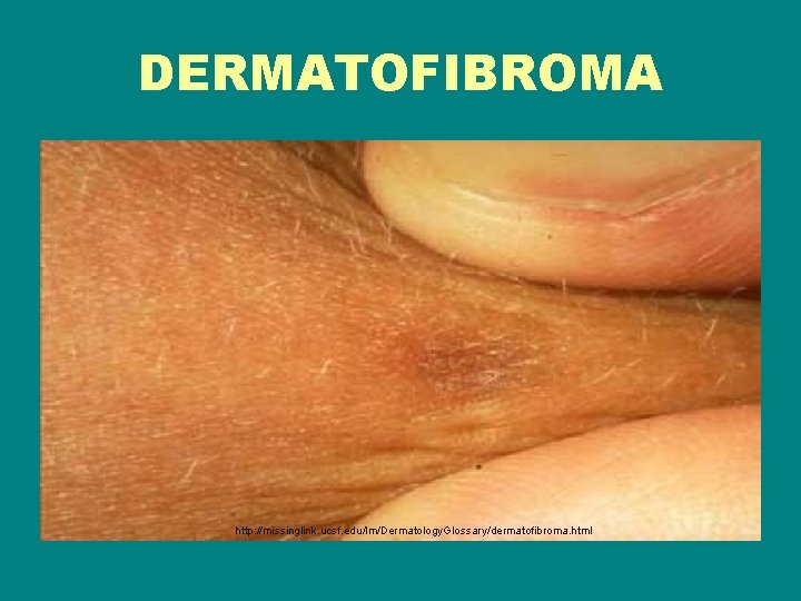 DERMATOFIBROMA http: //missinglink. ucsf. edu/lm/Dermatology. Glossary/dermatofibroma. html 