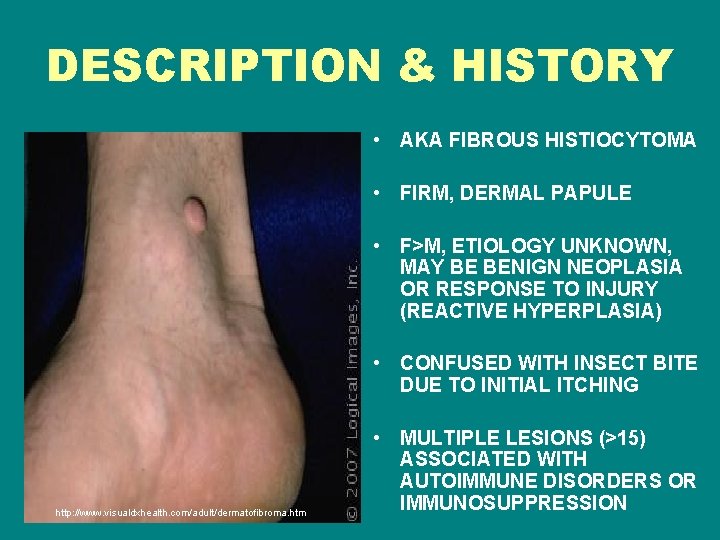 DESCRIPTION & HISTORY • AKA FIBROUS HISTIOCYTOMA • FIRM, DERMAL PAPULE • F>M, ETIOLOGY