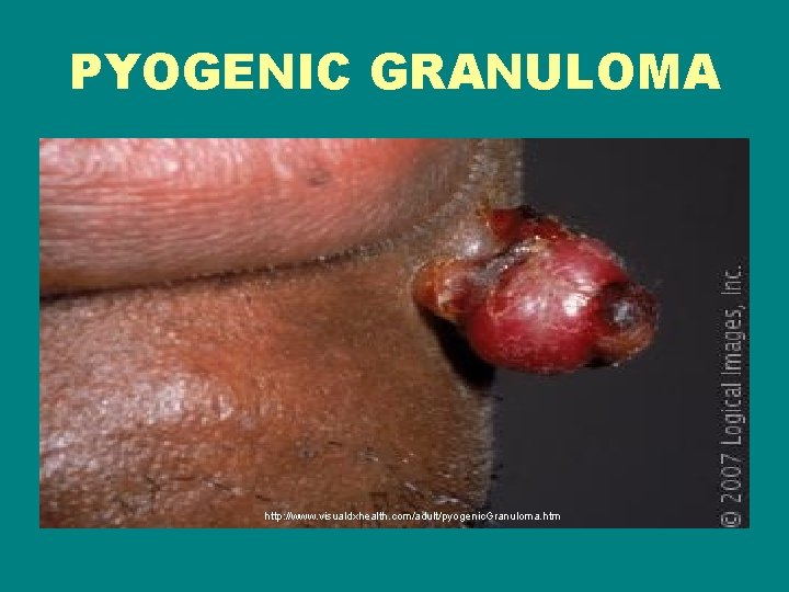 PYOGENIC GRANULOMA http: //www. visualdxhealth. com/adult/pyogenic. Granuloma. htm 