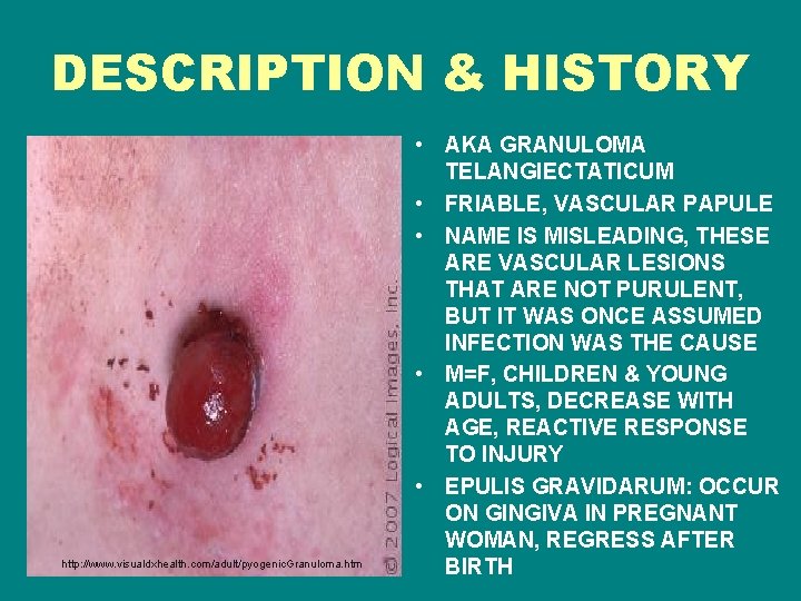 DESCRIPTION & HISTORY http: //www. visualdxhealth. com/adult/pyogenic. Granuloma. htm • AKA GRANULOMA TELANGIECTATICUM •