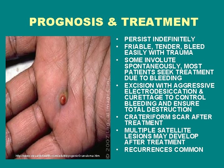 PROGNOSIS & TREATMENT • PERSIST INDEFINITELY • FRIABLE, TENDER, BLEED EASILY WITH TRAUMA •