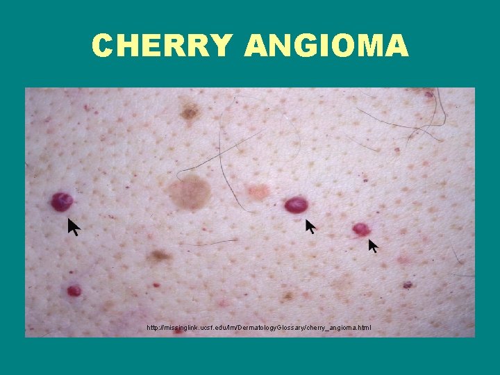 CHERRY ANGIOMA http: //missinglink. ucsf. edu/lm/Dermatology. Glossary/cherry_angioma. html 