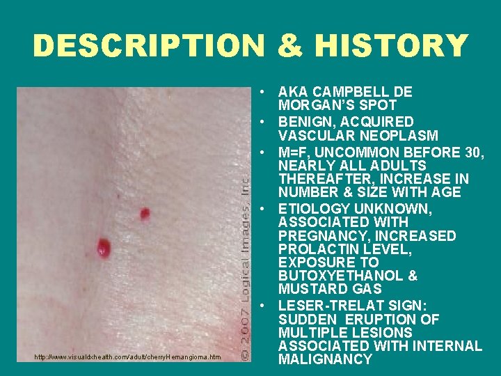 DESCRIPTION & HISTORY http: //www. visualdxhealth. com/adult/cherry. Hemangioma. htm • AKA CAMPBELL DE MORGAN’S