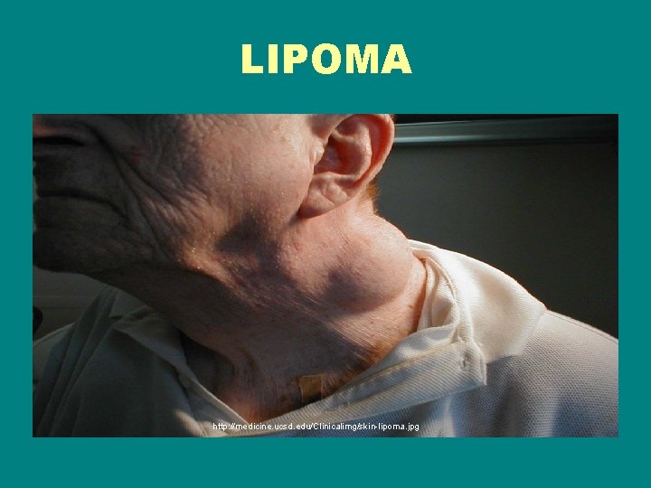 LIPOMA http: //medicine. ucsd. edu/Clinicalimg/skin-lipoma. jpg 