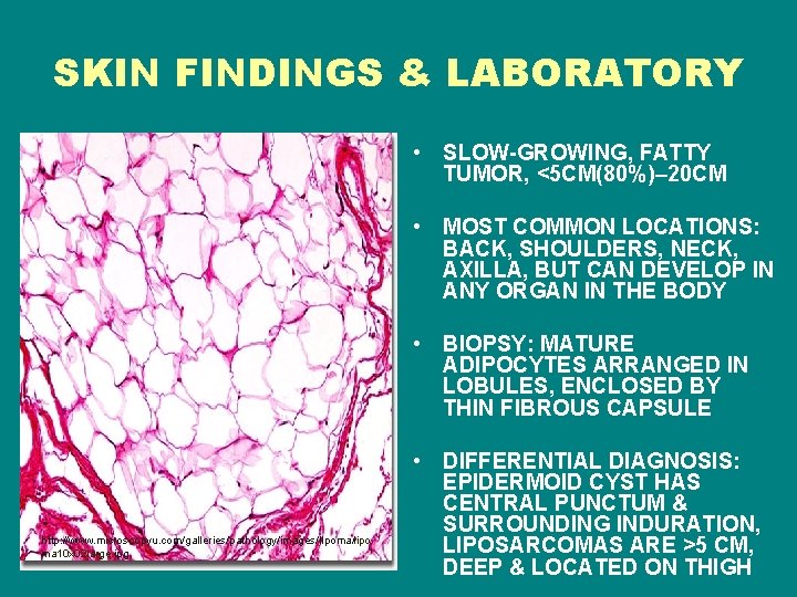 SKIN FINDINGS & LABORATORY • SLOW-GROWING, FATTY TUMOR, <5 CM(80%)– 20 CM • MOST