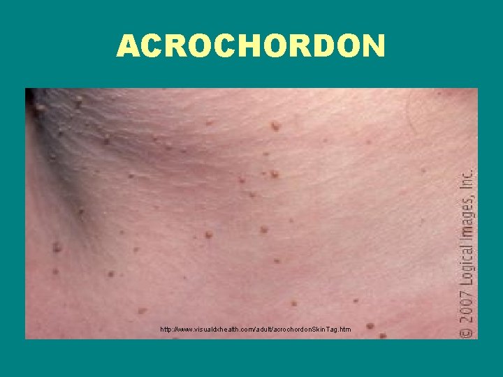 ACROCHORDON http: //www. visualdxhealth. com/adult/acrochordon. Skin. Tag. htm 