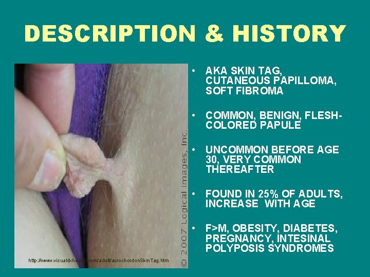 DESCRIPTION & HISTORY • AKA SKIN TAG, CUTANEOUS PAPILLOMA, SOFT FIBROMA • COMMON, BENIGN,