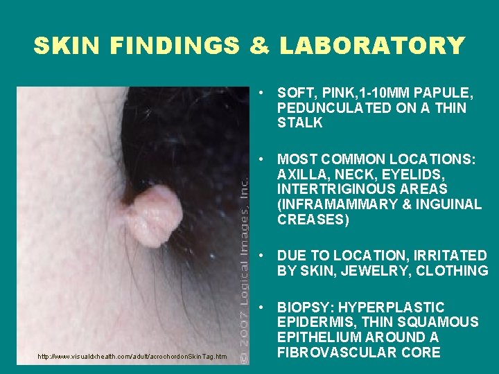 SKIN FINDINGS & LABORATORY • SOFT, PINK, 1 -10 MM PAPULE, PEDUNCULATED ON A