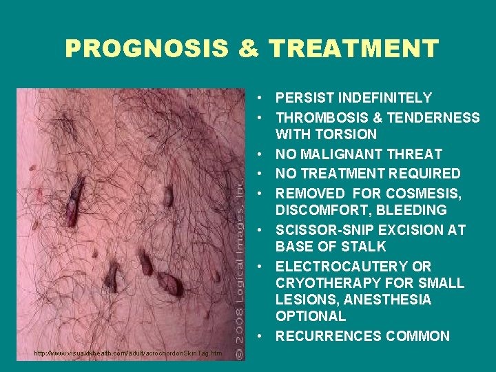 PROGNOSIS & TREATMENT • PERSIST INDEFINITELY • THROMBOSIS & TENDERNESS WITH TORSION • NO