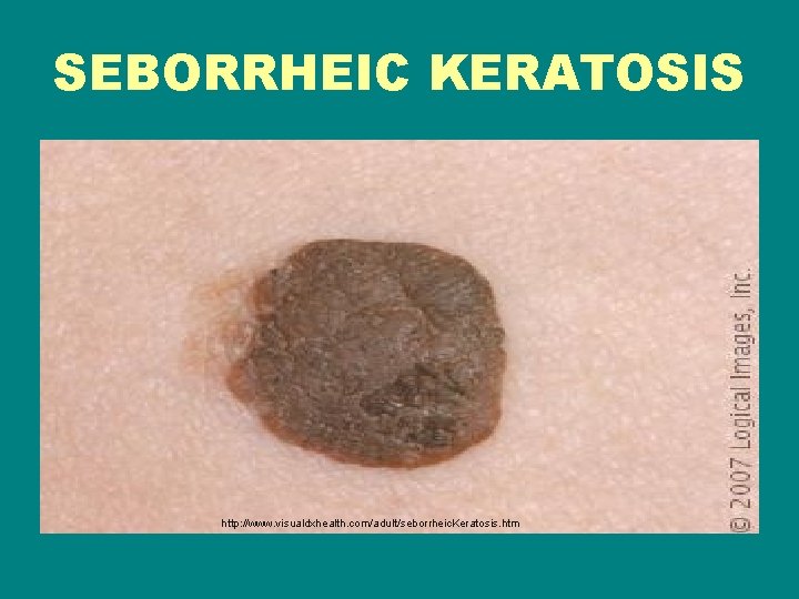 SEBORRHEIC KERATOSIS http: //www. visualdxhealth. com/adult/seborrheic. Keratosis. htm 