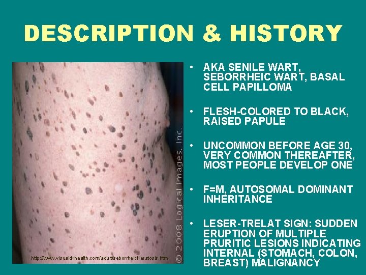 DESCRIPTION & HISTORY • AKA SENILE WART, SEBORRHEIC WART, BASAL CELL PAPILLOMA • FLESH-COLORED