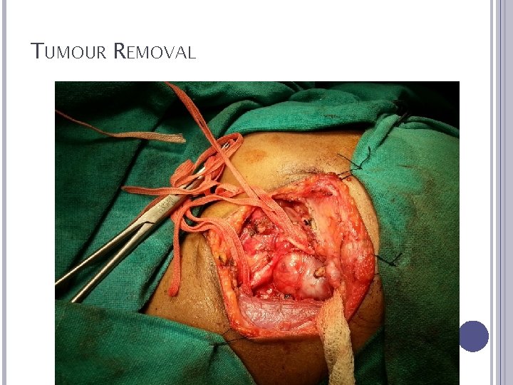 TUMOUR REMOVAL 