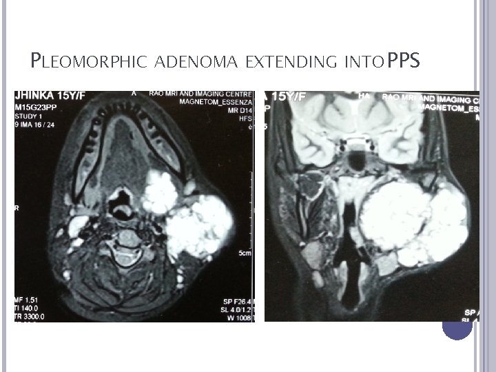 PLEOMORPHIC ADENOMA EXTENDING INTO PPS 