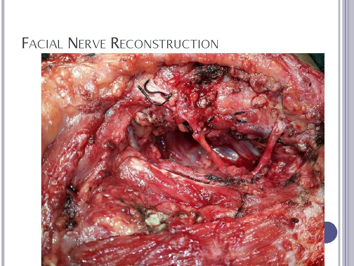 FACIAL NERVE RECONSTRUCTION 