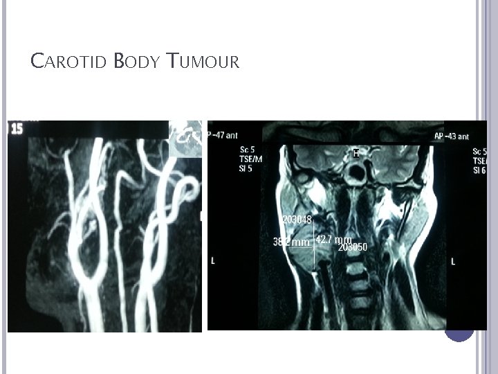 CAROTID BODY TUMOUR 