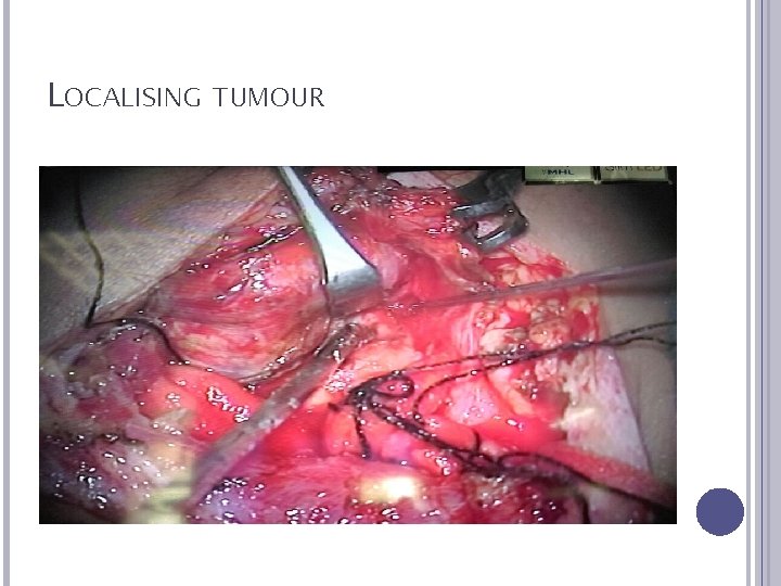 LOCALISING TUMOUR 