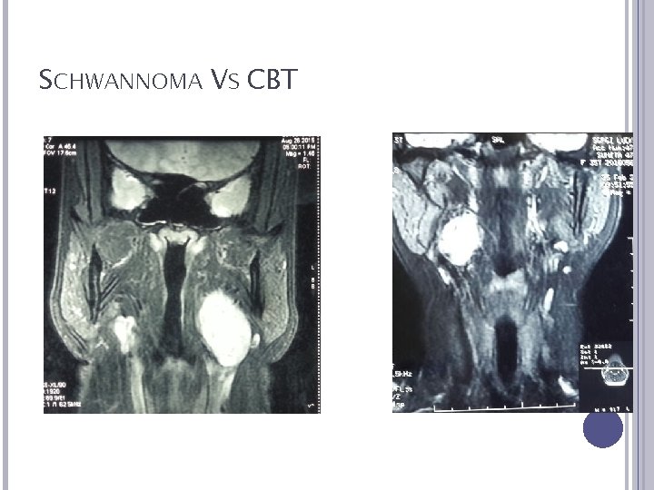 SCHWANNOMA VS CBT 