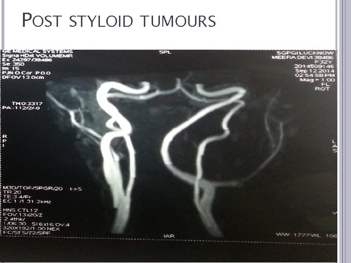 POST STYLOID TUMOURS 