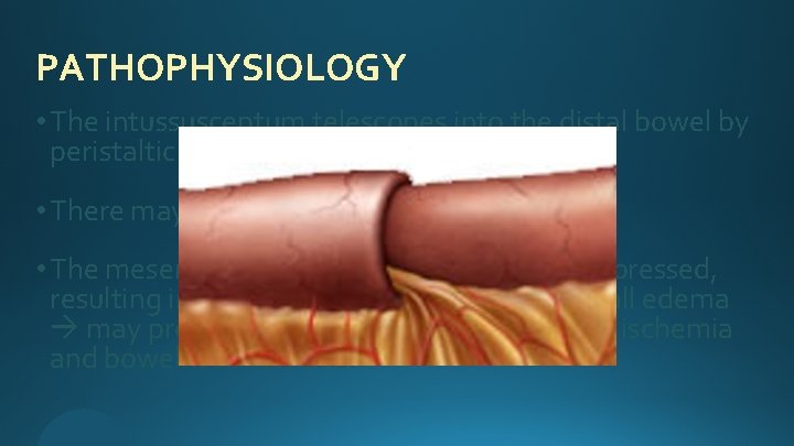 PATHOPHYSIOLOGY • The intussusceptum telescopes into the distal bowel by peristaltic activity. • There