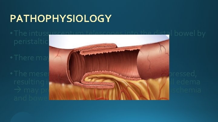 PATHOPHYSIOLOGY • The intussusceptum telescopes into the distal bowel by peristaltic activity. • There