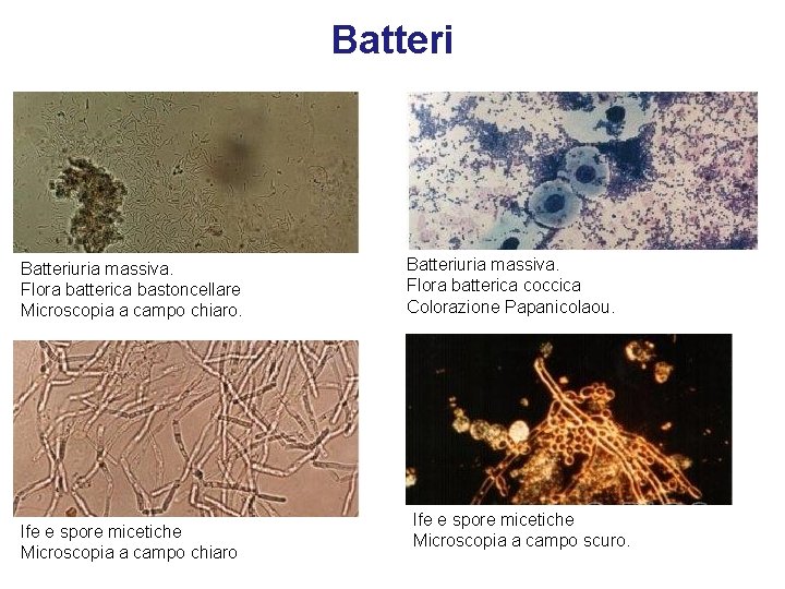 Batteriuria massiva. Flora batterica bastoncellare Microscopia a campo chiaro. Ife e spore micetiche Microscopia