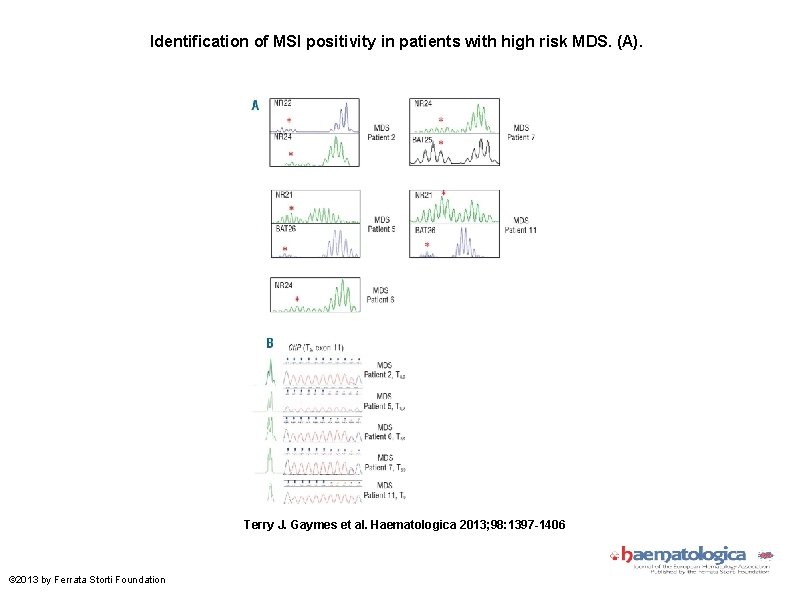 Identification of MSI positivity in patients with high risk MDS. (A). Terry J. Gaymes Identification of MSI positivity in patients with high risk MDS. (A). Terry J. Gaymes