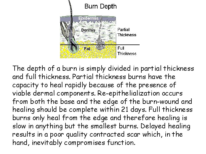 The depth of a burn is simply divided in partial thickness and full thickness.