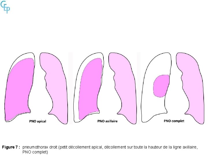 Figure 7 : pneumothorax droit (petit décollement apical, décollement sur toute la hauteur de