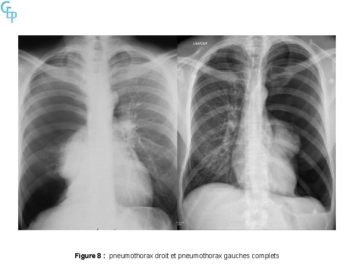 Figure 8 : pneumothorax droit et pneumothorax gauches complets 