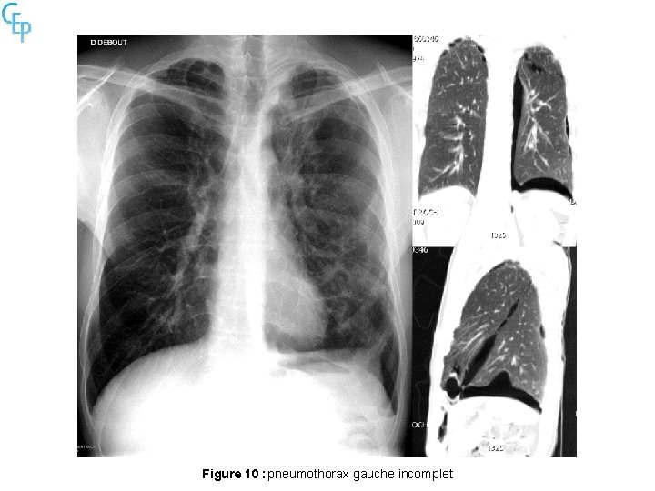 Figure 10 : pneumothorax gauche incomplet 