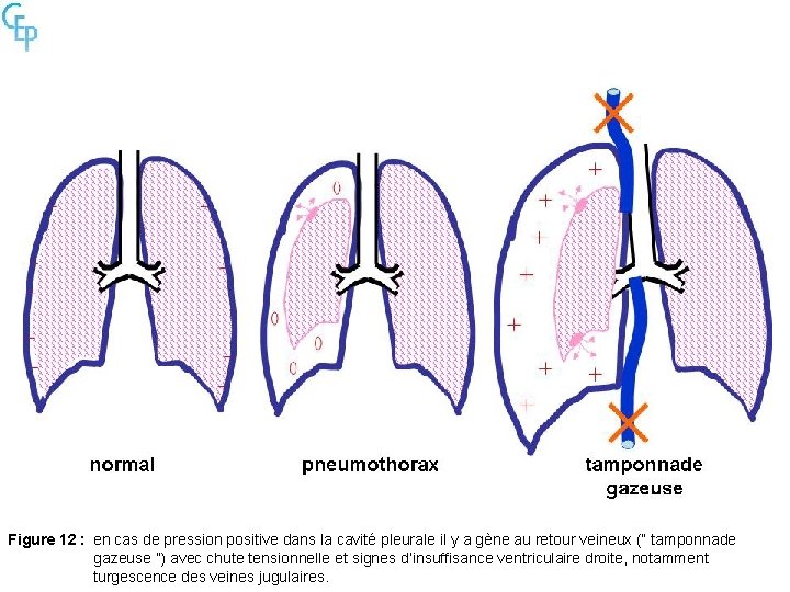 Figure 12 : en cas de pression positive dans la cavité pleurale il y