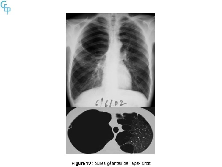 Figure 13 : bulles géantes de l’apex droit 