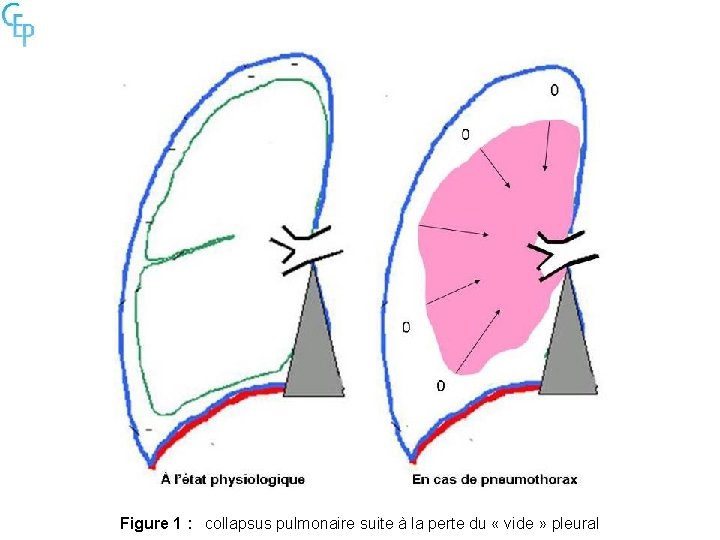 Figure 1 : collapsus pulmonaire suite à la perte du « vide » pleural