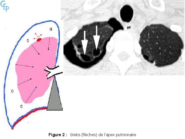 Figure 2 : blebs (flèches) de l’apex pulmonaire 