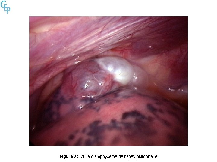 Figure 3 : bulle d’emphysème de l’apex pulmonaire 