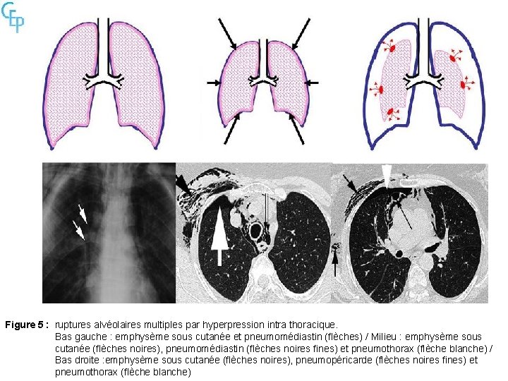 Figure 5 : ruptures alvéolaires multiples par hyperpression intra thoracique. Bas gauche : emphysème