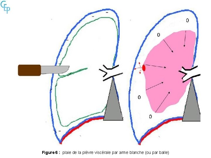 Figure 6 : plaie de la plèvre viscérale par arme blanche (ou par balle)